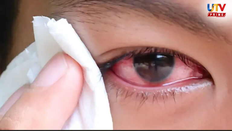 கண்களில் சிவப்பு, எரிச்சலா?.. மிரட்டும் ‘மெட்ராஸ் ஐ’ குறித்த முழுமையான விழிப்புணர்வு..! Madras Eye UTv