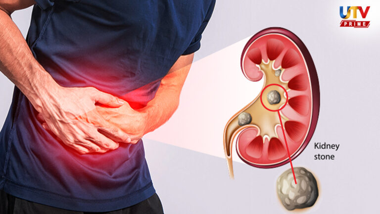 இந்த ஒரு மூலிகை டீ போதும்.. 14 நாட்களில் சிறுநீரகத்தில் உள்ள கற்களை ஓட ஓட விரட்டும்..! kidney stone UTv