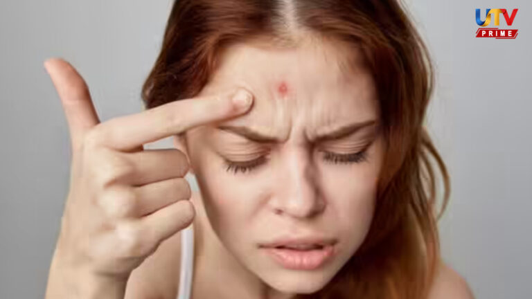 how-to-treat-summer-heat-blisters-tips