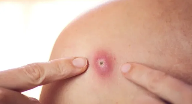 how-to-treat-summer-heat-blisters-tips