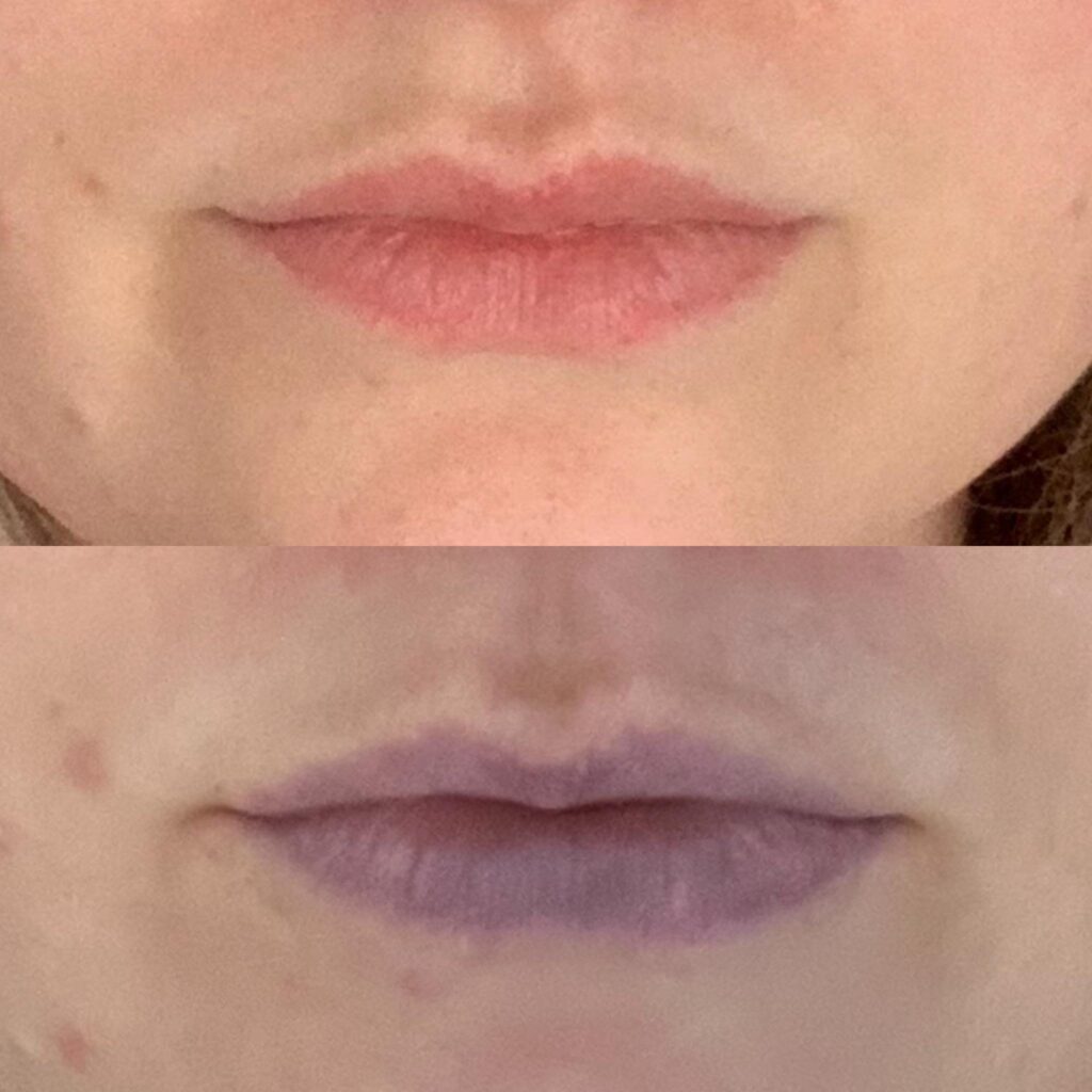 Six heart disease symptoms visible on lips